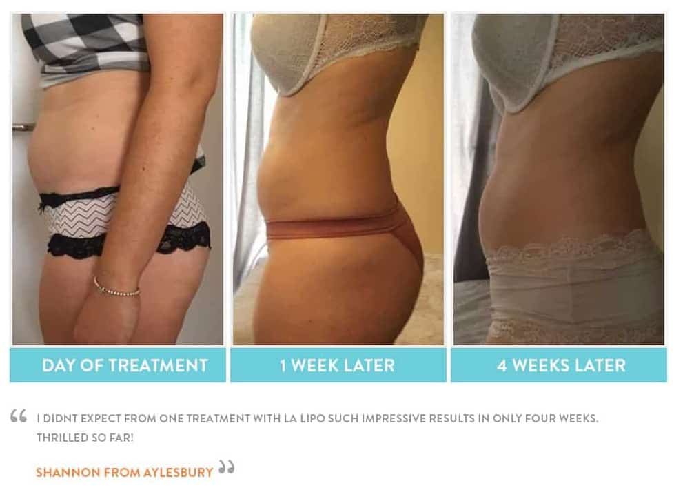before, Cryolipolysis Earls Barton