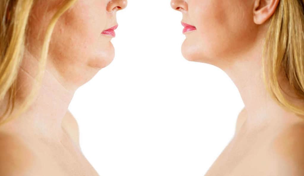 Double Chin treatment Earls Barton before and after results