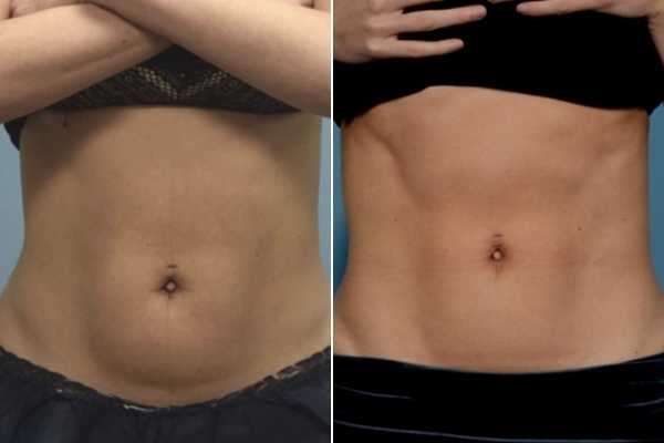 body sculpting FAQs Earls Barton