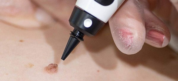 After Skin Tag Removal Earls Barton