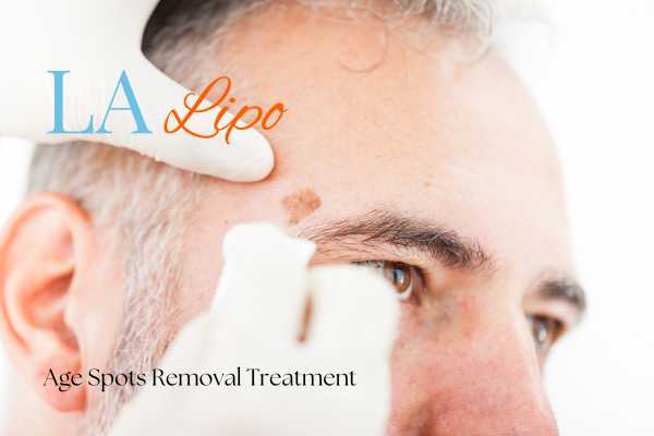 What Are the Most Effective Treatments for Age Spots Earls Barton?