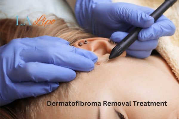 Dermatofibroma Removal Treatment Earls Barton