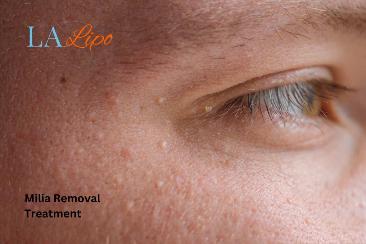 Cryopen Milia Removal: Is It the Easiest and Safest Option Earls Barton?