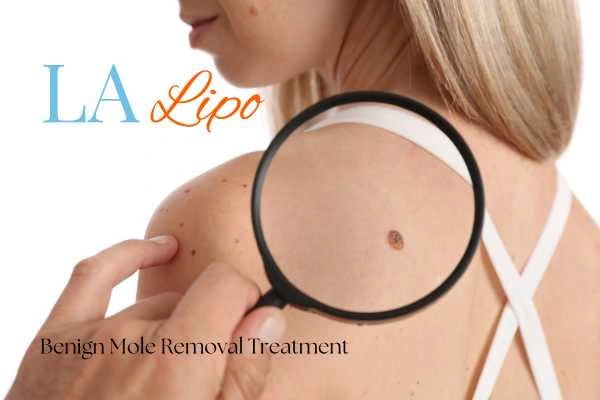 Why getting moles removed Earls Barton can boost your confidence!