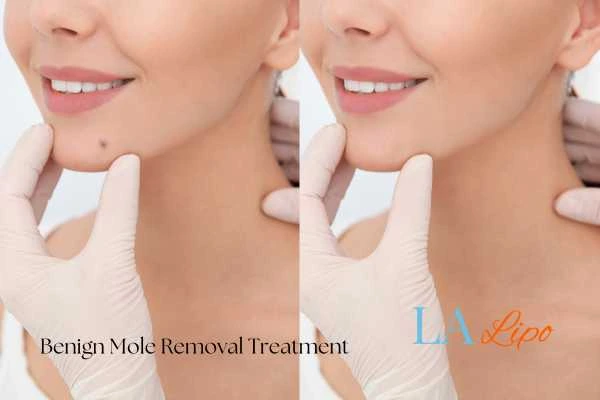 woman's before and after mole removal Earls Barton results