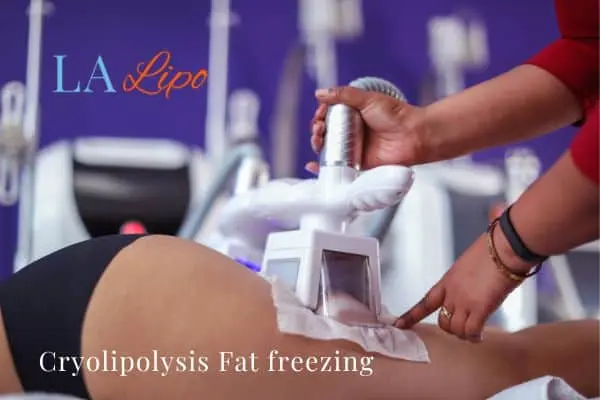 women getting fat freezing Earls Barton