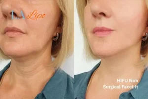 hi-fu for wrinkles Earls Barton before and after results