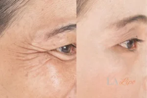 Before and after results of woman - HI-fu wrinkles reduction treatment Earls Barton