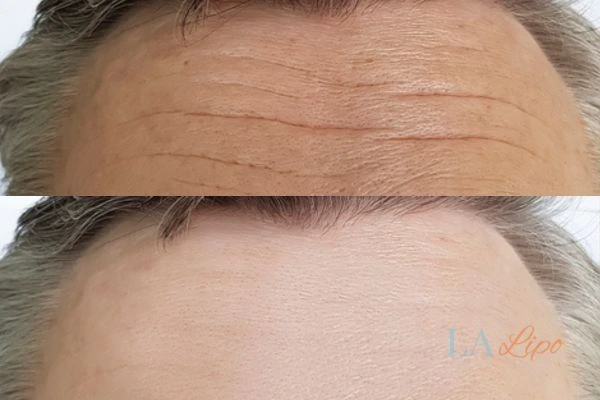 results of HIFU Earls Barton on mans forehead to help reduce lines and wrinkles