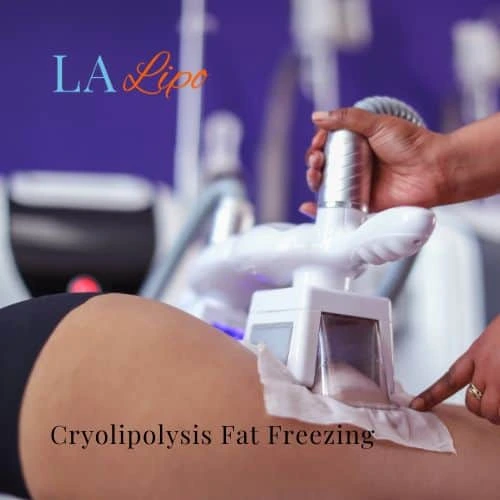 fat freezing - Cryolipolysis Earls Barton