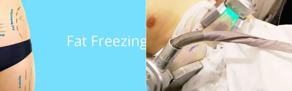 multi areas of a persons body having coolsculpting Earls Barton treatment