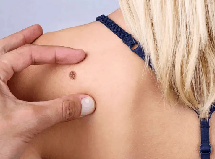woman having mole removal Earls Barton consultation before treatment.