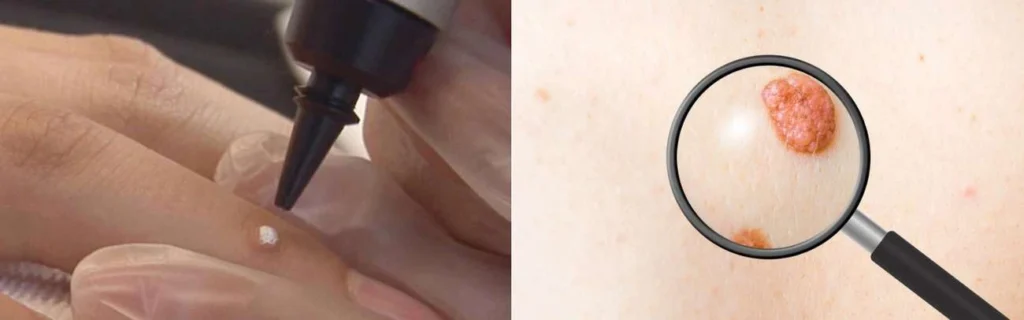 Person getting moles removed with cryopen Earls Barton