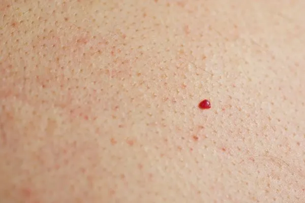 close up of a cherry angioma Earls Barton