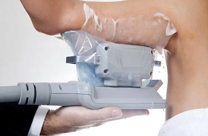 Picture of fat freezing Earls Barton on the upper arms.
