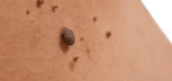 image of a skin tag Earls Barton