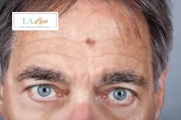 Solar Lentigo Removal Earls Barton image of man with mark on his forehead