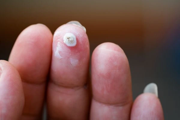 wart on person finger - cryotherapy to treat from LA LIPO Earls Barton