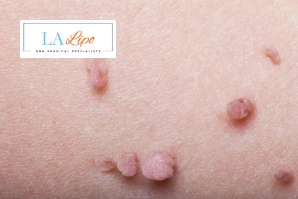 Does cryopen skin tag removal Earls Barton hurt? Find out now call our team today!