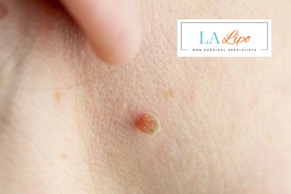 Book skin tag removal Earls Barton today speak to our team now!