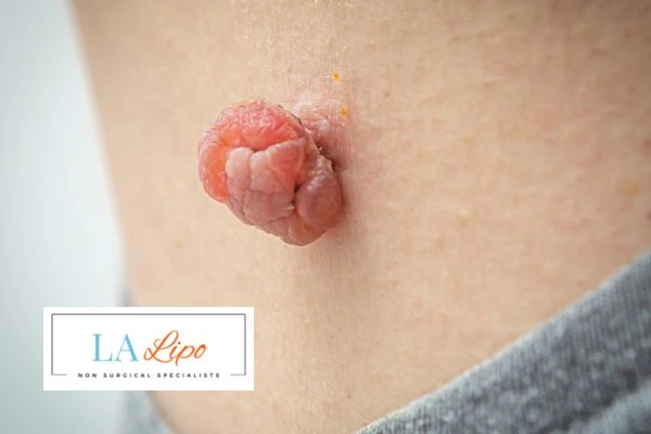 Interested in skin tag removal Earls Barton? Concerned about the pain? Find out more today!