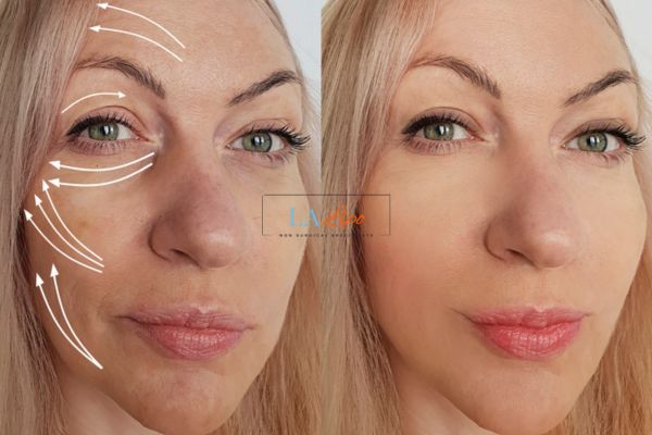 Morpheus 8 results Earls Barton face lift.
