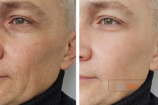 See the amazing results of Morpheus8 Treatment Earls Barton!