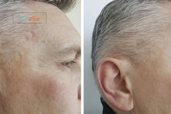 Mens Before & After Morpheus 8 Results Earls Barton
