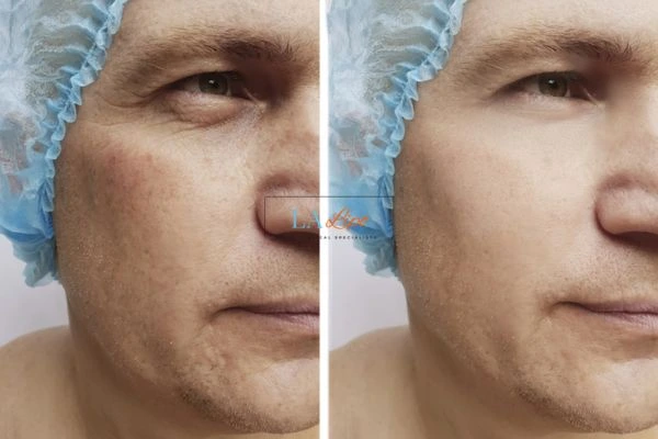 Before and after Morpheus 8 Results Earls Barton
