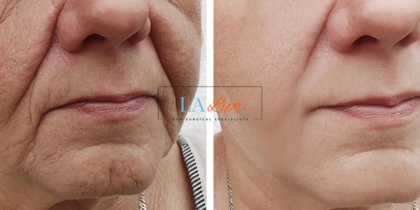 Older lady deeper wrinkle reduction - LA LIPO Morpheus 8 Results Earls Barton