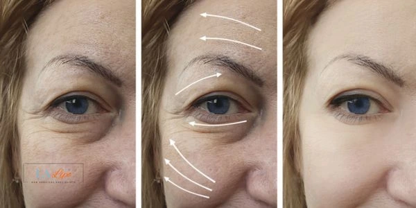 Amazing eye lift Morpheus 8 results Earls Barton
