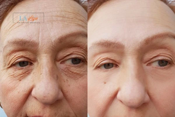 The powerful benefits of Morpheus8 Treatment Earls Barton - Call Our team today!