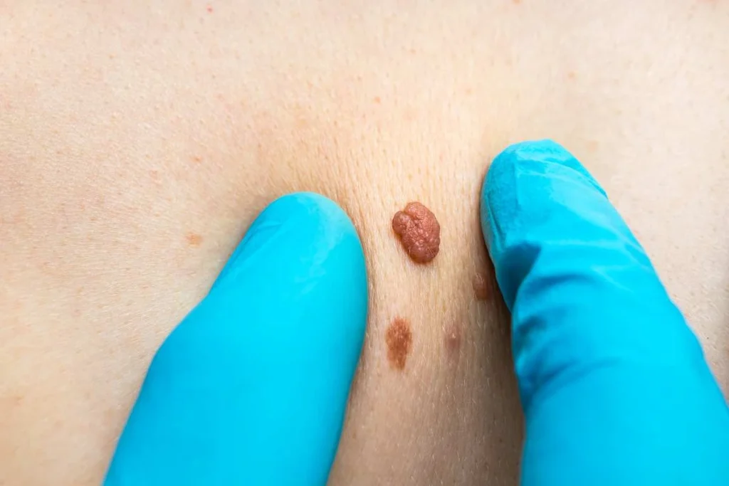 LA LIPO Cryopen Lesion Removal Prices Earls Barton
