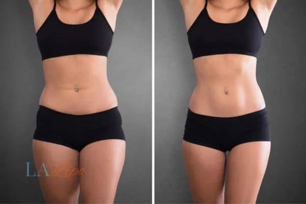 before and after results of non-surgical treatment to help a woman's body image and mental health Earls Barton