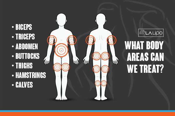 Diagram to show areas you can have LA-EMS Body Sculpting Treatment Earls Barton