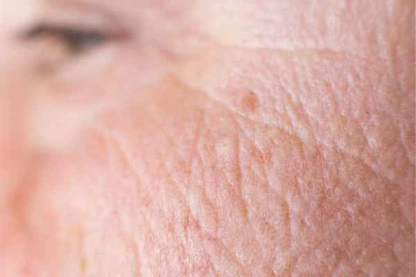 close up picture of a woman's face showing an age spot Earls Barton