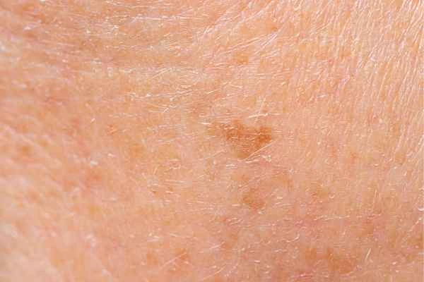 close up picture of age spots Earls Barton