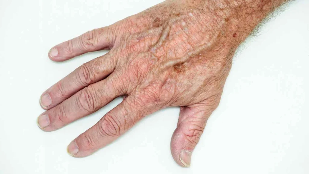 Male hand showing age spot Earls Barton