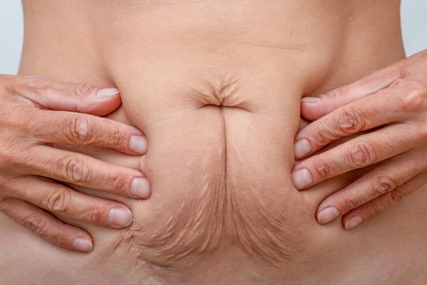 Image of a woman's stomach with loose skin - example of skin tightening Earls Barton options