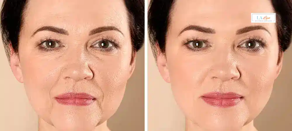 How Long Does It Take to See Results and How Long Do They Last Earls Barton?
