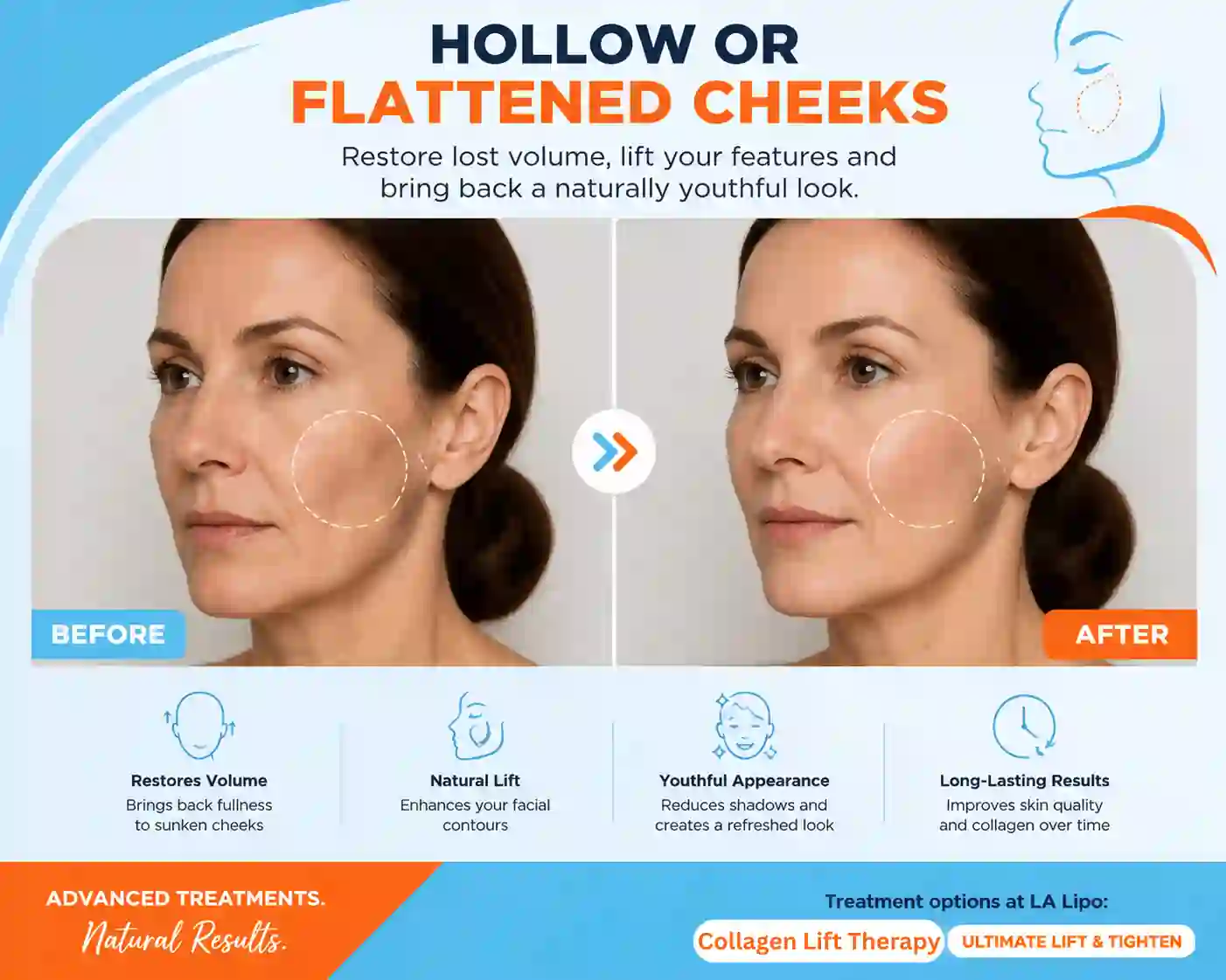 Sign #4: Hollow or Flattened Cheeks Earls Barton