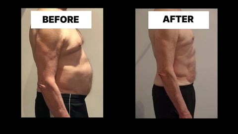 What Symptoms Can Diastasis Recti Cause in Men? Weak Core, Back Pain and Poor Posture Earls Barton